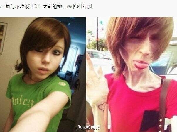 美国少女患极度厌食症 体重仅36斤_手机凤凰网