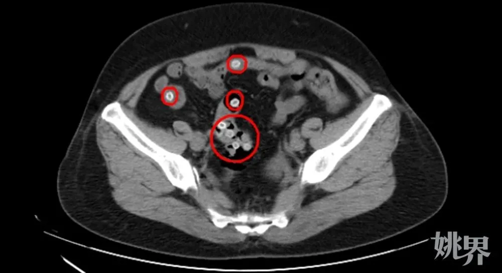 CT影像显示，患者肠道内有不少杨梅核滞留