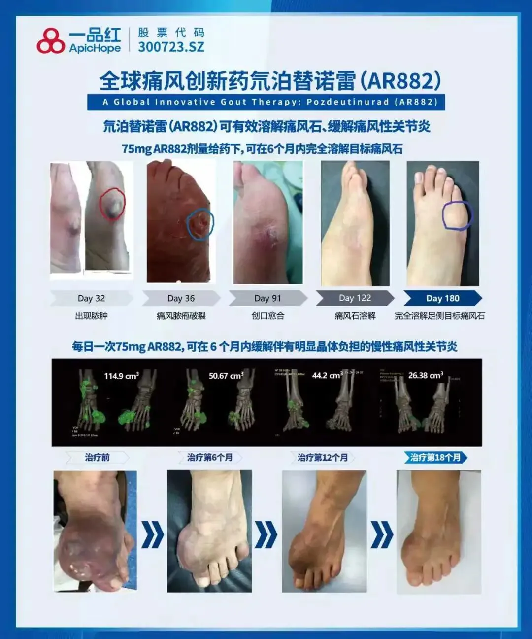 痛风“神药”，押注AI_https://www.izongheng.net_快讯_第2张