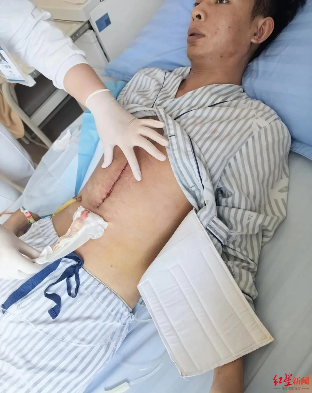 ▲杨先生术后腹部留下的伤口