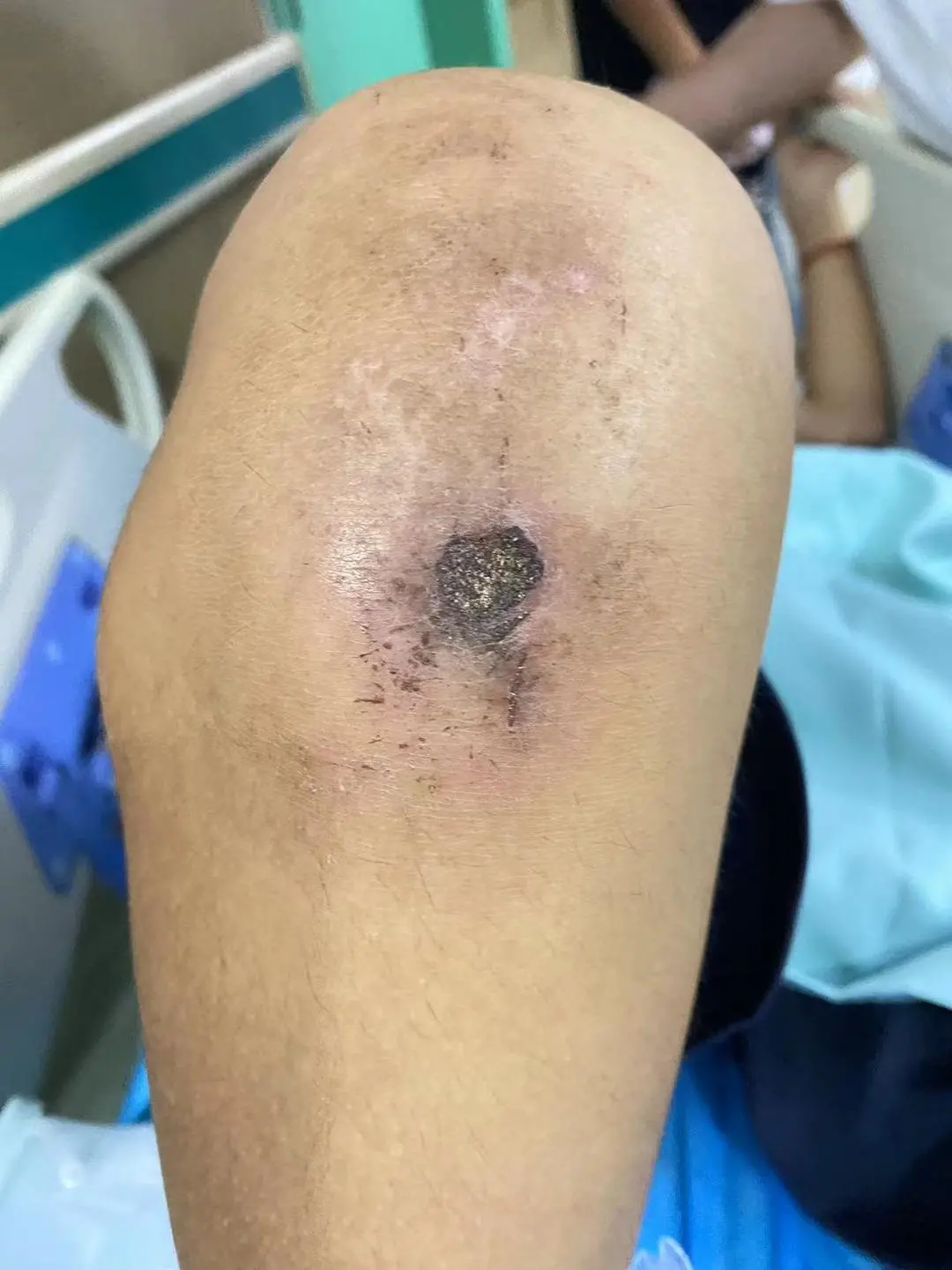 ▲小武的膝盖伤痕 图据受访人