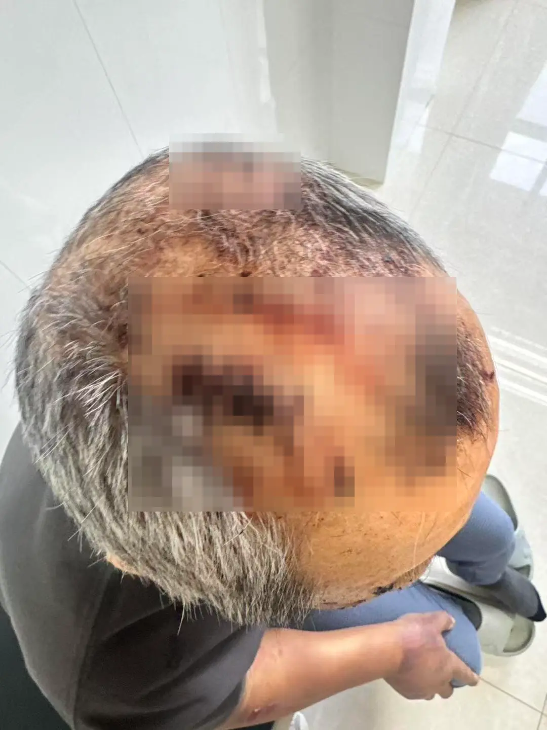 ▲马女士父亲头部被缝针
