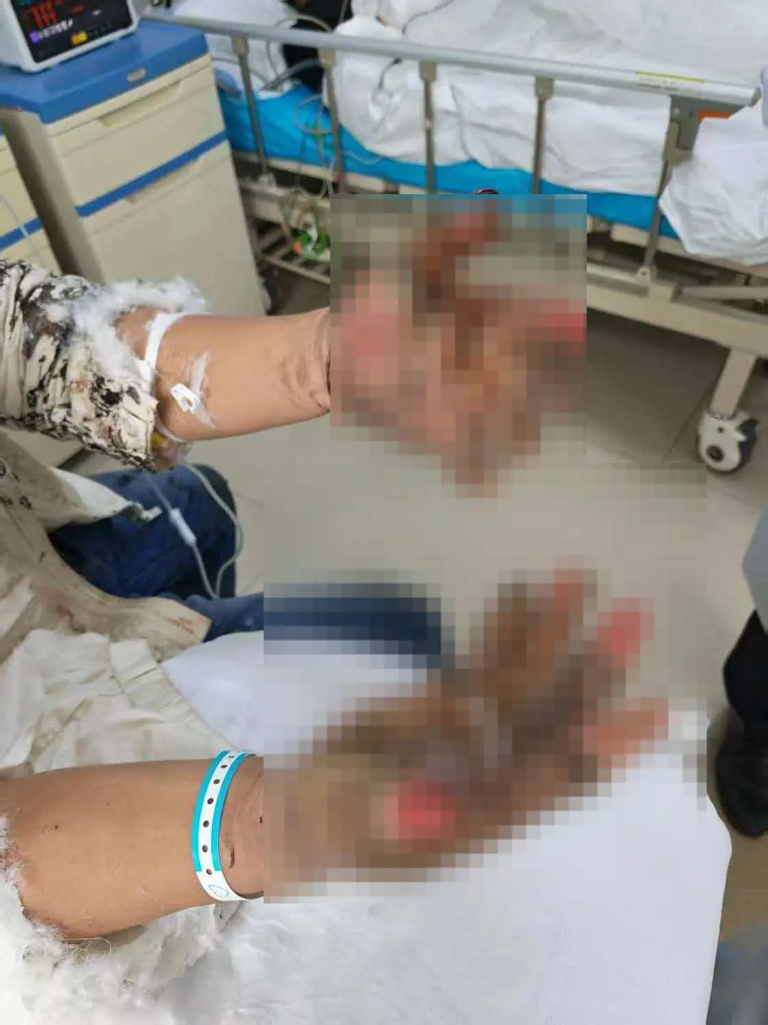 ▲王某因救人双手被烧伤