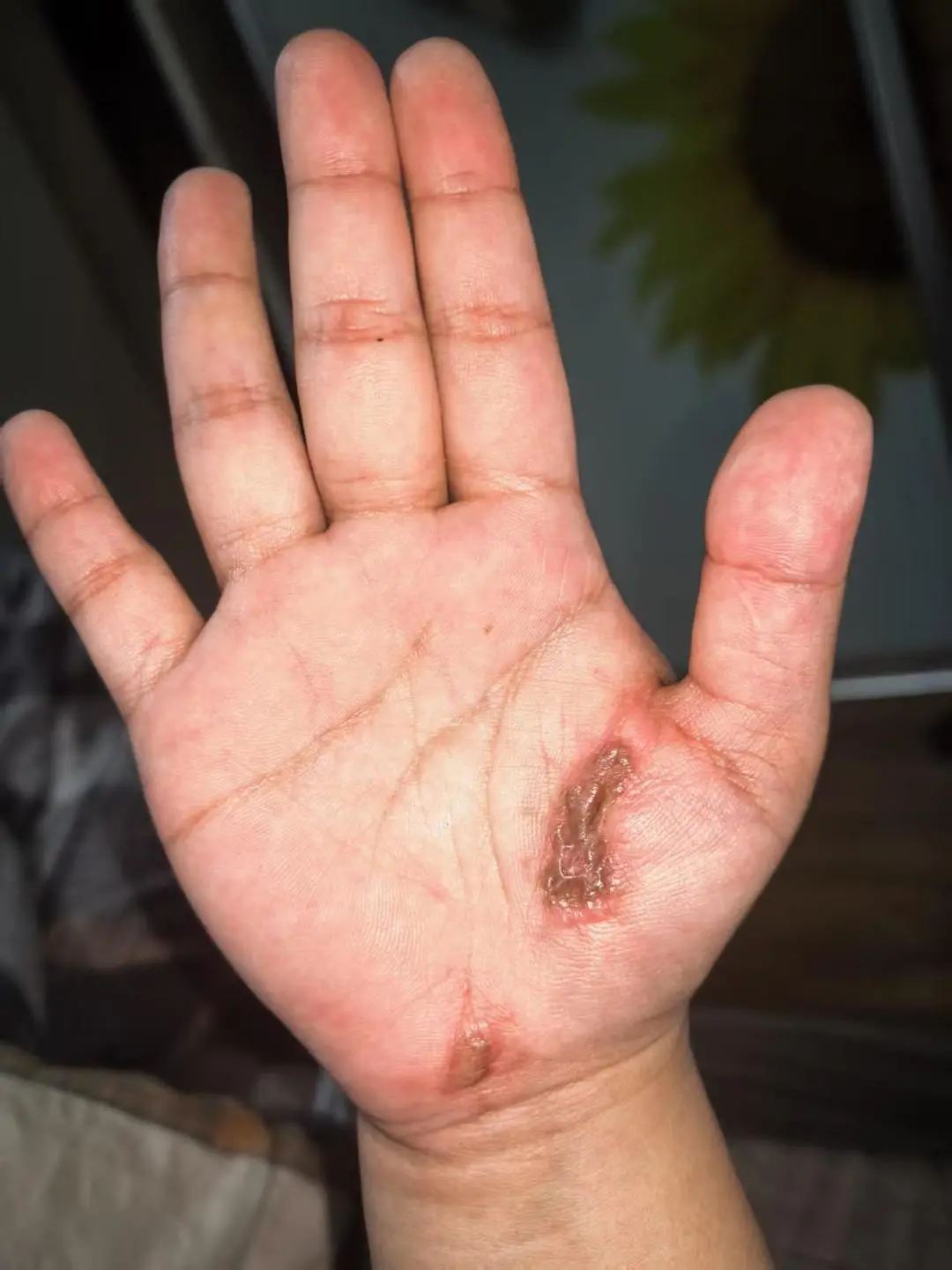 女子称边充电边玩手机遭电击，从手到脚击穿全身