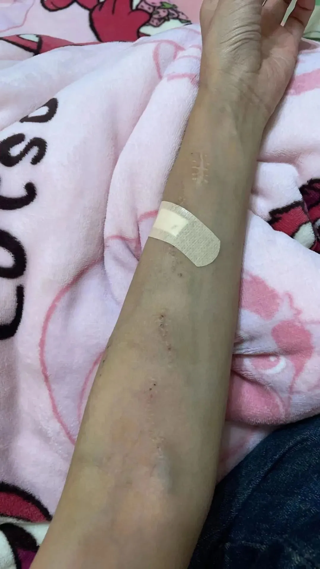 靠近手腕的伤口，是乌拉拉做动、静脉连接手术留下的