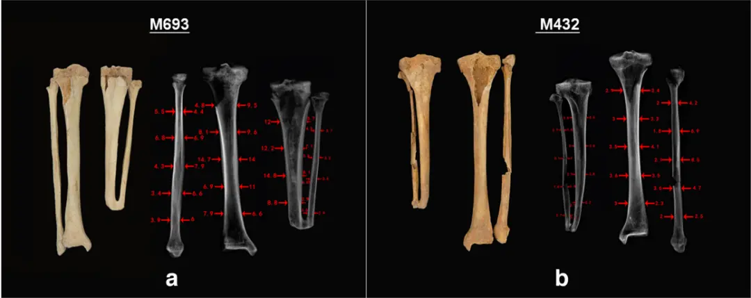 男子（M693）左小腿1/5的胫骨和腓骨远端被截，生理长度缩短了约8厘米，左脚也完全缺失；另一名男子（M432）右小腿1/5 的胫骨和腓骨远端被截肢，生理长度缩短了约8厘米，右脚完全缺失。图片截自《东周时期刑罚和医疗制度背景下的惩罚性截肢》研究报告。