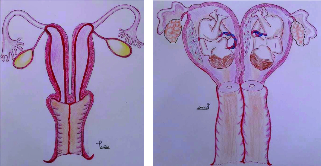 手绘双子宫双胎妊娠。图源/Case Report in Obstetrics and Gynecology