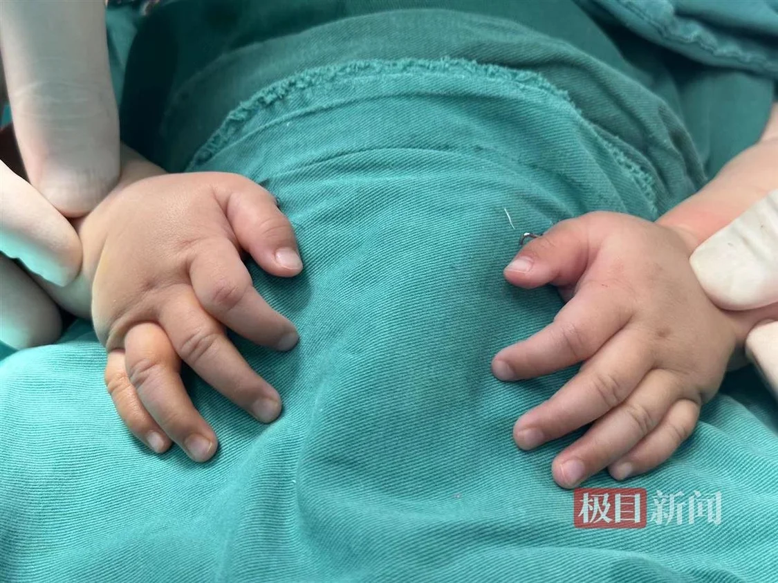 全国首例！武汉专家“透视眼”下切除“蟹钳宝宝”多余手指-首批赴武汉专家组成员
