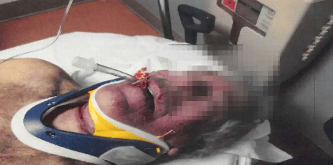 ▲照片显示，爱泼斯坦脸部红肿，脖子上有勒痕