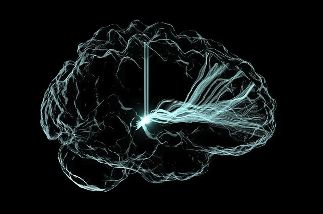 大脑植入物帮助患者改善认知