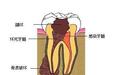 蛀牙会坏到哪种程度？