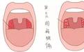 扁桃体发炎怎么办?这些情况下切除扁桃体对孩子会更好