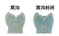 儿童牙齿窝沟封闭怎么做？