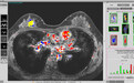 降低39%乳腺癌漏诊率！FDA批准首个AI辅助诊疗系统
