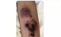 拯救“烂胳膊”，局部组织坏死这样“起死回生”！