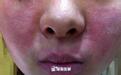 每到冬天，皮肤又红又烫、瘙痒难耐？5招破解肌肤敏感“魔咒”