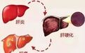 肝癌三部曲：肝炎一不小心就会变肝癌