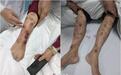 男子皮肤奇痒夜不能寐，手脚溃烂都痒不停？糖尿病+并发症！
