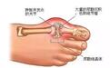 关于痛风的四个不同时期以及症状