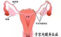 中国女性患者福音！拜耳子宫内膜异位症新药Visanne（地诺孕素）获中国批准