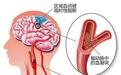 除了脑中风，颈动脉斑块脱落的危害非常大！科学防治请牢记这3招