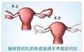 为什么输卵管复通术后怀不上？主要是这两种原因