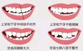 关于矫正，牙齿片切、扩弓、磨牙远移、支抗钉、拔牙，这些你都了解过吗？
