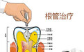 牙髓炎有哪些患病特征？怎么自行判断？