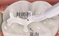 窝沟封闭到底是什么意思？有什么用？