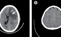 《柳叶刀》：人工智能可识别九类急性脑CT异常