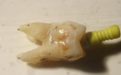 根管治疗，一根针插在牙齿里到底有多痛？