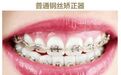 牙齿矫正是什么？牙齿矫正会改变脸型吗？