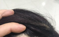 梅花针治疗脱发的使用技巧