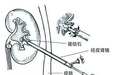 患者须知：经皮肾镜碎石取石术后注意事项