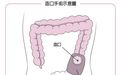 肛门切除后挂袋是什么样子