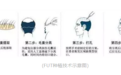 植发到底是什么样的？