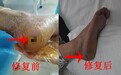糖尿病足伤口怎么修复治疗？重建血液回路循环是条件！