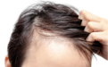 治疗脂溢性脱发的要点，不懂的难怪头发越掉越多