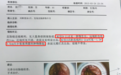 年轻直肠癌患者不愿意做改道手术，还有没有其它办法？
