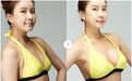 做自体脂肪丰胸时一定要看这两点！