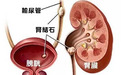 如何预防肾结石？这4大食疗方法必须知道！