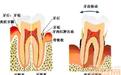牙齿患牙龈炎怎么办？
