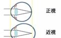 总是戴眼镜视力会下降吗？