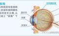 天才科技艾眼分享——常见的眼部疾病及其预防办法（下）