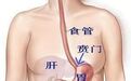 如果你有胃痛，不妨先了解一下什么是“幽门梗阻”！