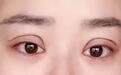 双眼皮修复手术为什么比双眼皮手术难？
