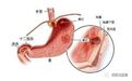 胃竟然也会“崩溃”？原来是急性糜烂性胃炎的病发所致！