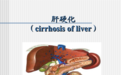 肝硬化的发生的4大因素