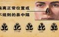 反复鼻塞流涕，涕中还带血？从事这些职业的人，小心铬鼻病！