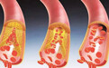 4个症状说明血管堵塞 自然界的溶栓王让你的血管一通到底